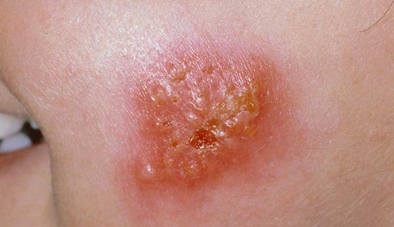 楊浩康(Yeung Ho Hong)醫生講解甚麼是膿瘡病 (Impetigo)？